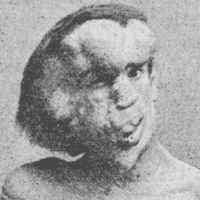 Joseph Merrick